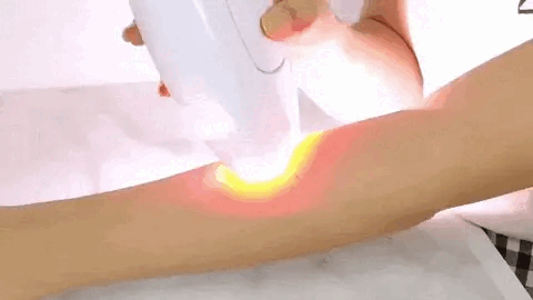 Depilador Láser Ipl