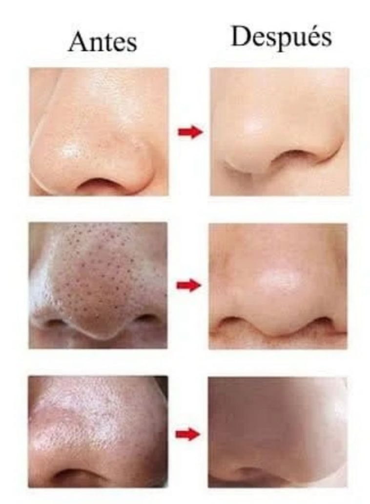 💎 Extractor Profesional de Espinillas y Puntos Negros