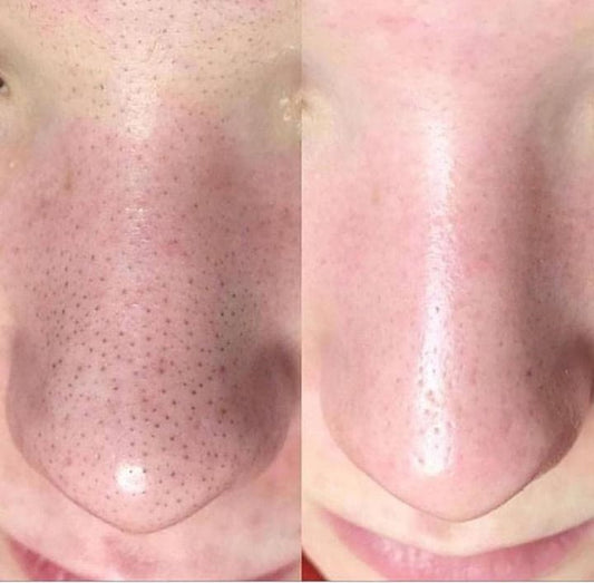 💎 Extractor Profesional de Espinillas y Puntos Negros